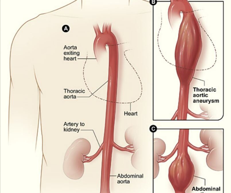 Aorta aneurizma